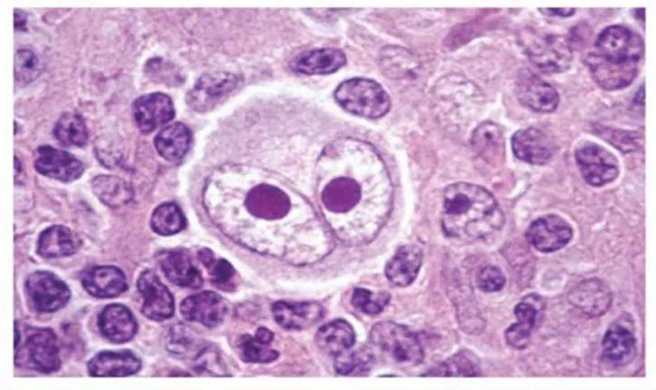 Lymphoma