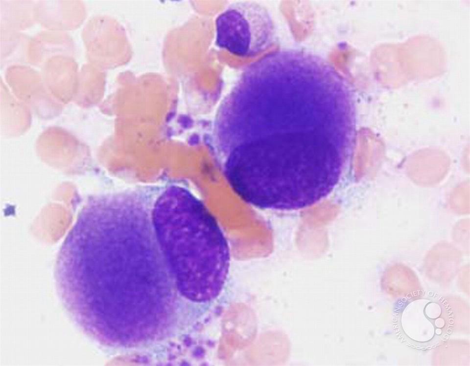 Myelodysplastic Syndromes